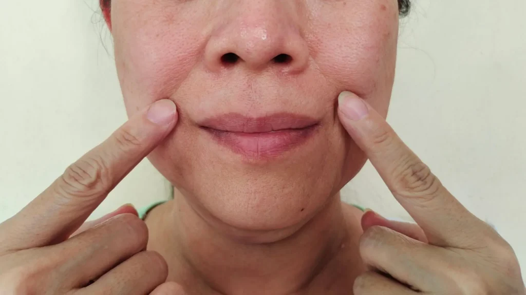 Căng Da Rãnh Cười Thermage FLX Có Làm Cứng Biểu Cảm Không