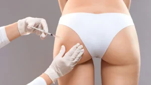 Giá Tiêm Filler Mông Bao Nhiêu ở Bệnh Viện HCM