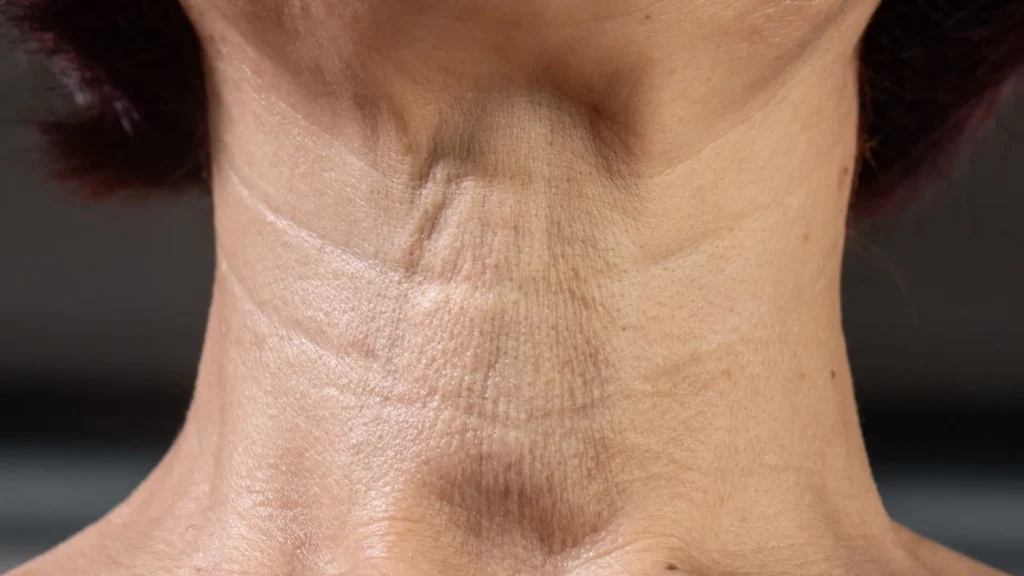 Mất Elastin ảnh Hưởng đến độ Săn Chắc Vùng Cổ Ra Sao
